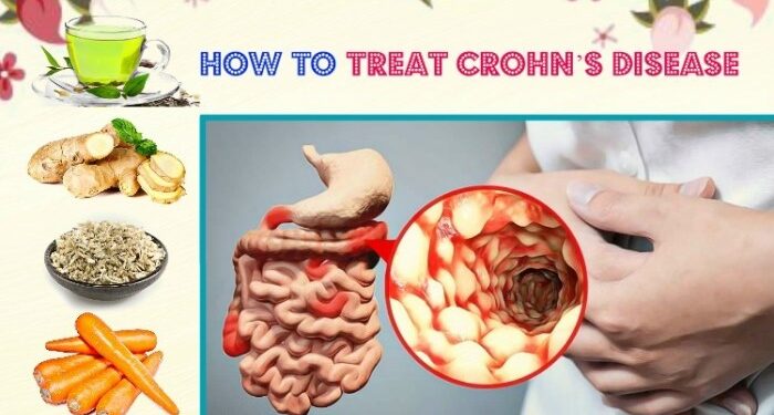 Natural Remedies to Treat Crohn's and Colitis [Slideshow]